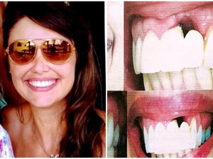 Dentista é condenada a pagar mais de R$ 50 mil por implante mal feito