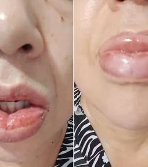 Colgate decide parar de fabricar o creme dental Clean Mint após reações alérgicas