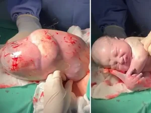 Bebê nasce empelicado e médico faz cócegas na barriga dele para acordá-lo