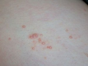 Molusco contagioso é de fácil transmissão e comum em crianças