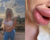 Influencer não consegue mais fechar a boca após preenchimentos labiais