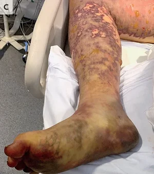 Jovem tem pernas amputadas após infecção por comida estragada