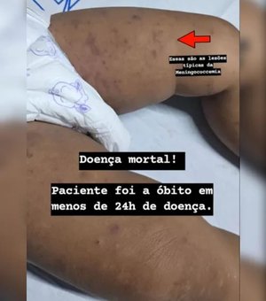 Criança de 1 ano morre com suspeita de meningite, em Maceió