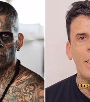 'Mais tatuado do Brasil' surge irreconhecível após passar por nova sessão de remoção de tatuagens no rosto