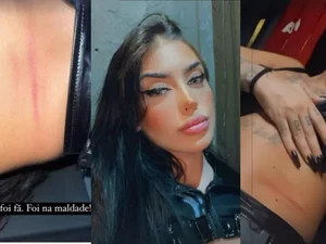 Mirella mostra marcas pelo corpo e desabafa: 'Não foi fã, foi na maldade'