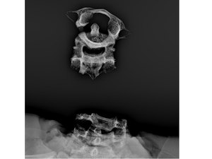 IML confirma que crânio encontrado é de jovem decapitado