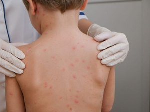 Alagoas lidera incidência de meningite no Nordeste e ocupa segunda posição no país