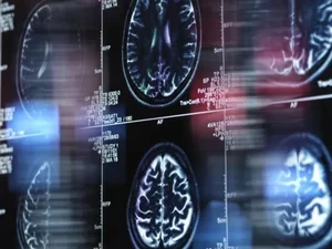 Chinês de 19 anos pode ser pessoa mais jovem com Alzheimer e causa é mistério para cientistas