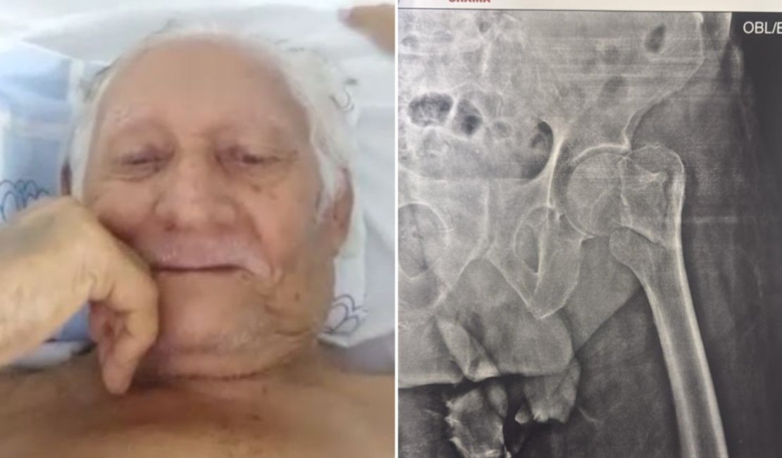 Idoso aguarda há quase 50 dias por cirurgia no colo do fêmur, em Arapiraca, e família aciona a justiça