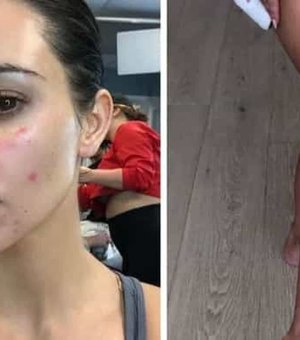 Kim Kardashian revela fotos que mostram marcas da psoríase