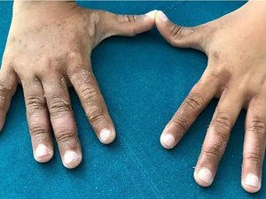 Criança fica com manchas e bolhas ao entrar em mar contaminado