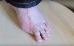 Após acidente de trabalho, homem tem dedo do pé implantado na mão 