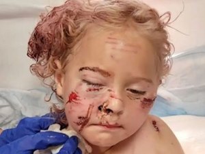 Menina de 5 anos leva 50 pontos no rosto após ataque de cachorro