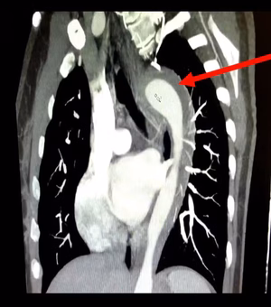 Em caso raro, mulher de 45 anos rompe aorta após orgasmo; entenda a condição