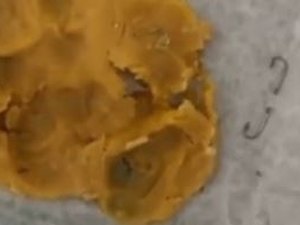 [Vídeo] Médico alagoano atende paciente que ficou com anzóis presos na boca após comer coxinha