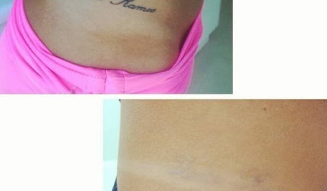 Nicole Bahls remove tatuagem com nome de ex-namorado