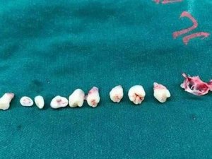 Dentes são removidos de cérebro de menino de 5 anos