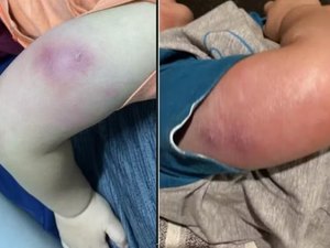 Bebê recebe alta após infecção grave pós-vacina em posto de saúde de Maceió