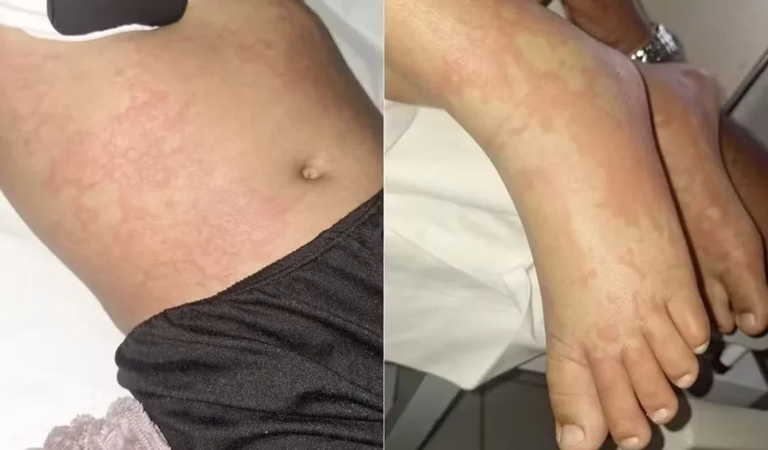 Menina de 10 anos luta contra infecção após contato com detergente Ypê