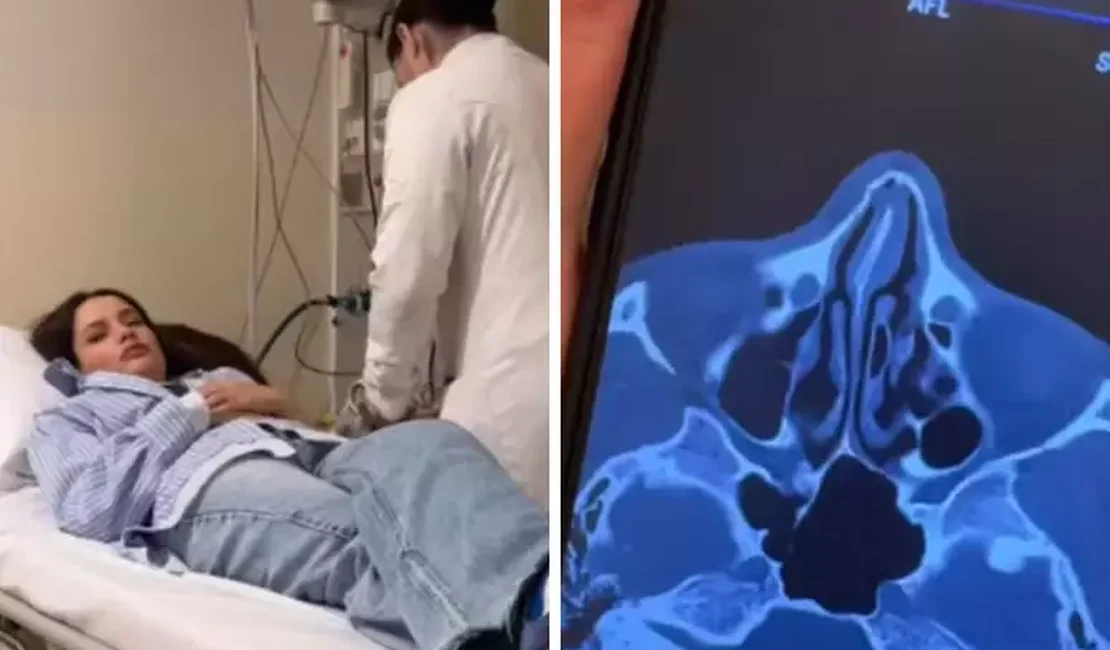 Juliette Freire fratura o nariz em acidente doméstico: 'Está meio torto'
