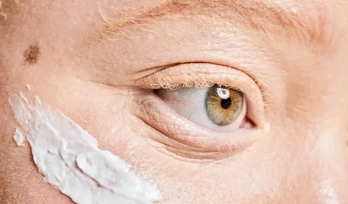 Pessoas com albinismo terão acesso gratuito a protetor solar em Maceió