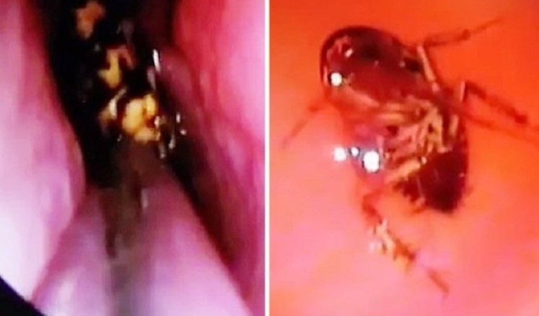 Médicos descobrem barata viva em crânio de mulher que se queixava de dores na cabeça