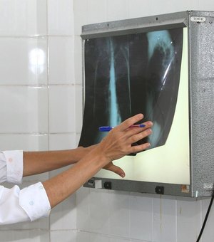 Brasil registra 200 casos de tuberculose por dia