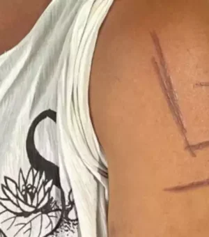 Mulher trans é marcada por suástica nazista após ser espancada por namorado e patrões