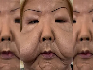 Juju do Pix mostra como ficou o rosto deformado após cirurgia