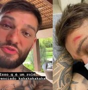 Lucas Lucco assusta fãs ao mostrar rosto desfigurado e dedo quebrado após acidente