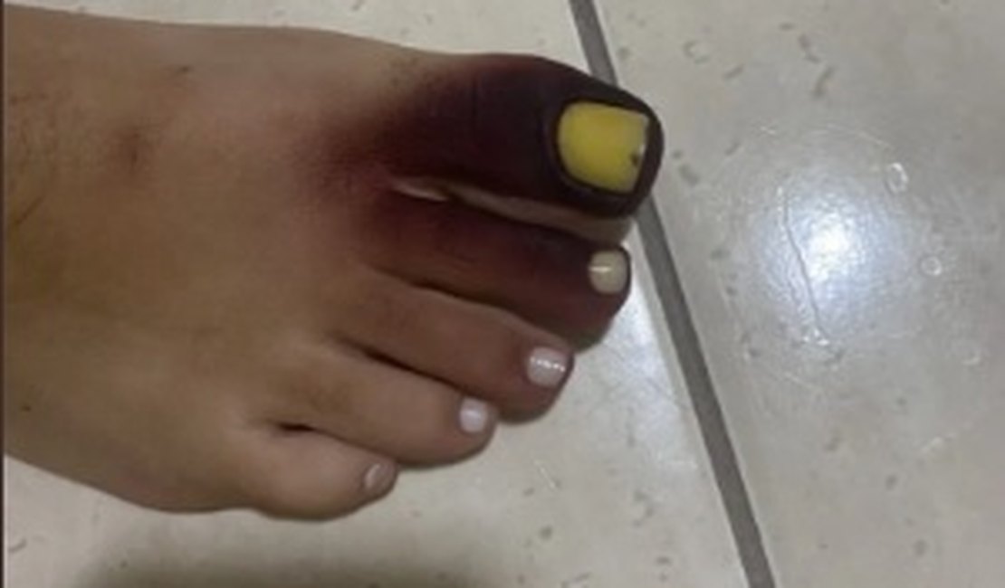 Mulher fica com dedos roxos após ter piolho-de-cobra preso no tênis
