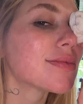 Virginia surge com lesão no olho após acidente envolvendo a filha