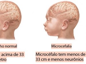 Casos de Microcefalia no Nordeste: Qual a causa para a manifestação da doença?