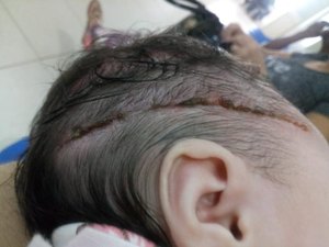 Durante parto recém-nascida é cortada  com bisturi e leva 25 pontos na cabeça 