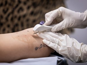 Saúde em Maceió disponibiliza inserção gratuita do Implanon