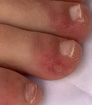 O que são os 'dedos de covid', um dos mais novos possíveis sintomas identificados da doença?