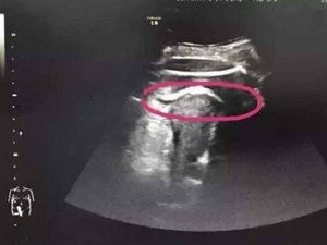 Mulher grávida quase morre após ‘chute’ do bebê romper o útero