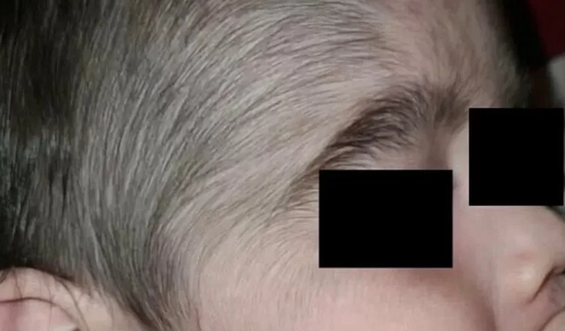 Minoxidil: produto anticalvície usado pelo pai fez crescer pelos em bebês