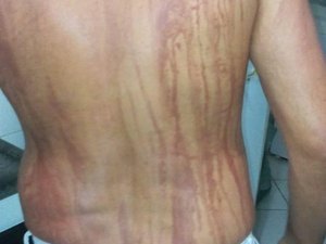 Turista que teve manchas no corpo após banho de mar na Bahia é internado 