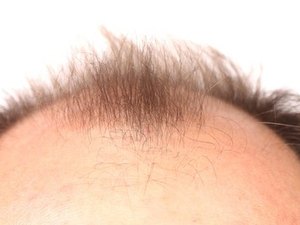 Cientistas encontram os culpados pela calvície