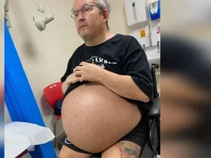 Médicos removem rins gigantes de 35 kg de paciente com doença hereditária