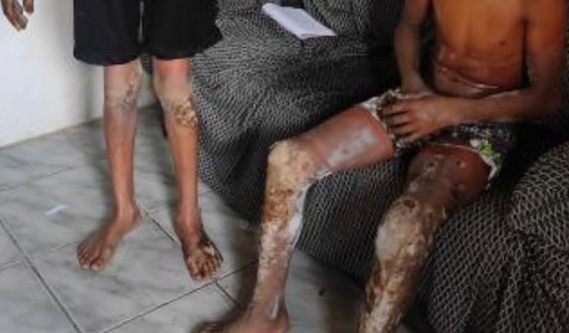 Menor que teve o corpo queimado por fogos de artificio é transferido para o HGE