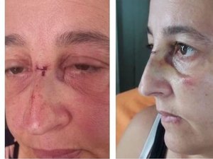 Após ataque com bexiga d’água, mulher leva pontos e pega infecção ocular