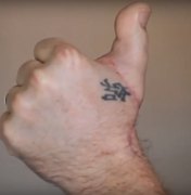 [Vídeo] Após acidente de trabalho, homem tem dedo do pé implantado na mão 