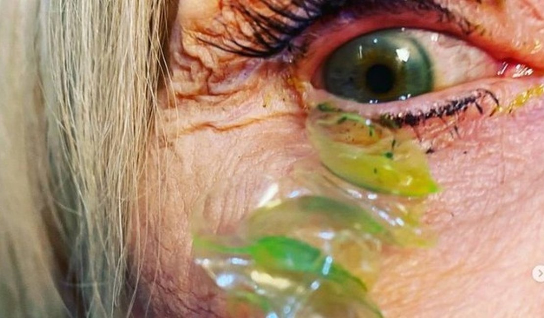 Oftalmologista retira 23 lentes de contato perdidas em olho de paciente; veja vídeo