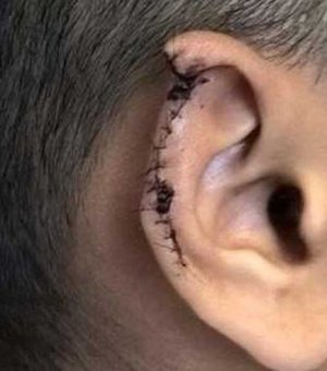 Jovem perde parte da orelha após ser mordido durante briga na zona rural de Pão de Açúcar