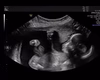 Bebê é vista 'dando soco' na mãe durante exame de ultrassom: 'Personalidade forte'