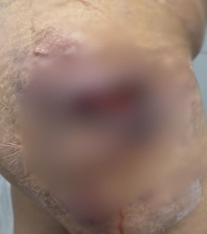 Dentista de Arapiraca é investigada por usar silicone industrial e necrosar glúteos de pacientes