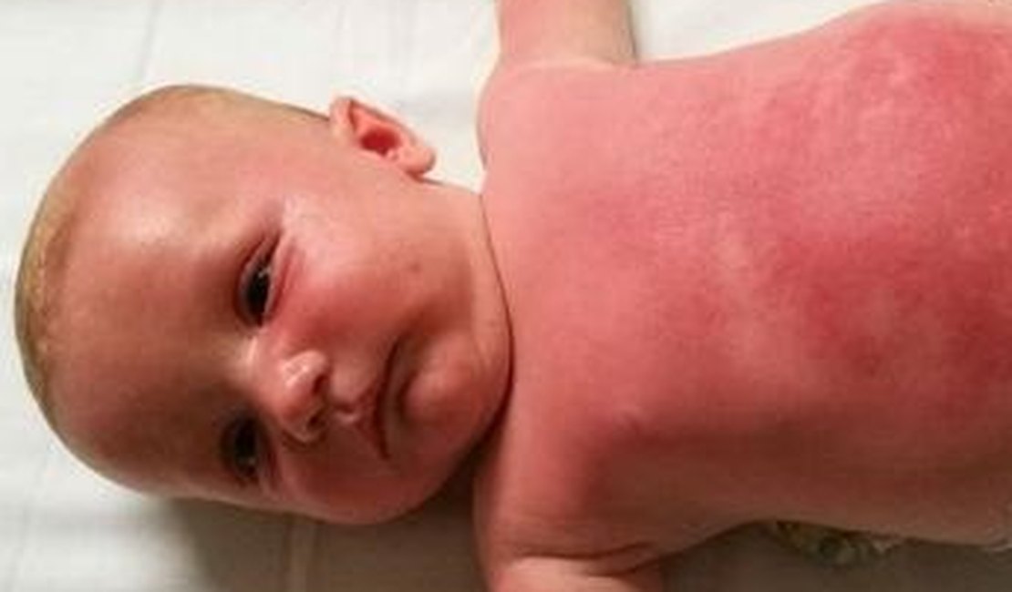 Bebê de 3 meses é internado após usar filtro solar da Peppa Pig
