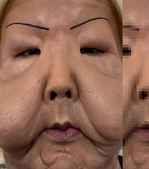 Juju do Pix vai colocar silicone após remover óleo mineral do rosto